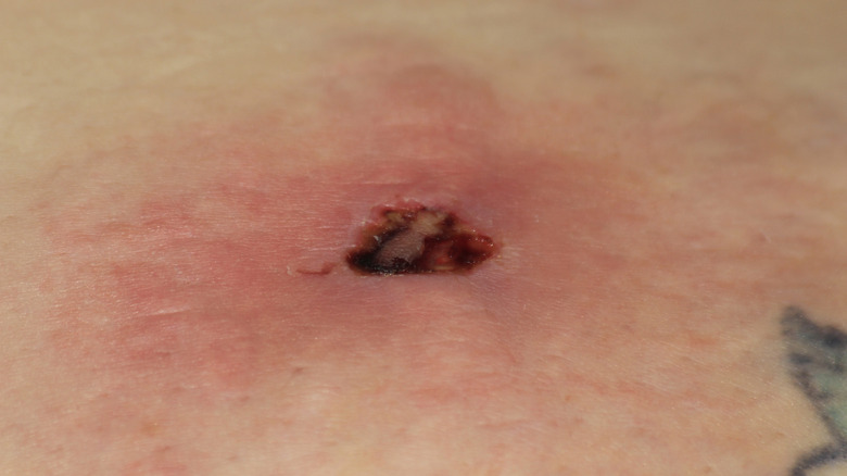 A pus-filled red area, depicting a brown recluse's bite.