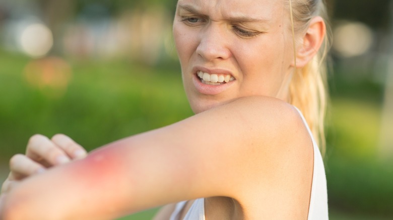 Woman in pain with red welt on her arm after getting stung
